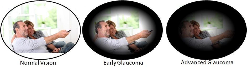 symptom-glaucoma