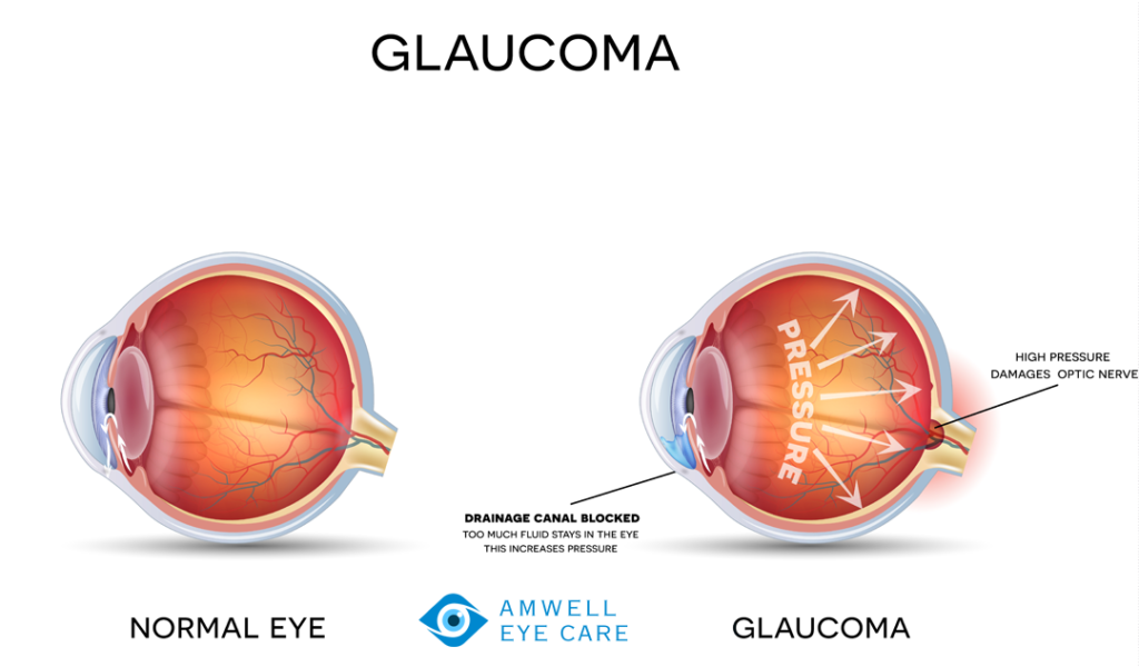 what-is-glaucoma