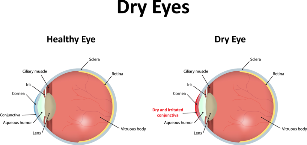 what-is-dry-eye